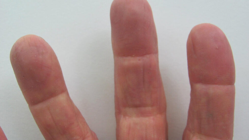 Rt-hand-silicone-restoration-detail