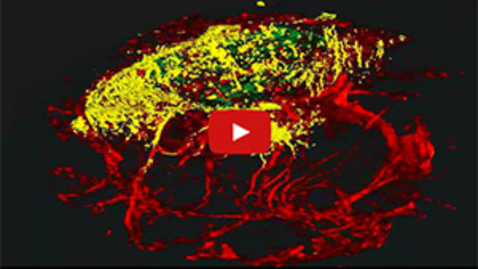 catching cancer early300