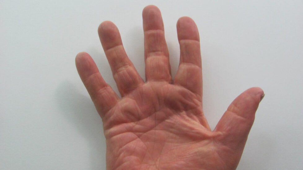 rit-hand-plnr-silicone-restoration