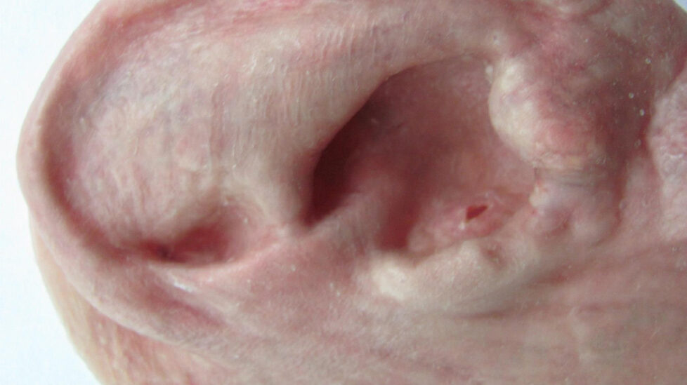 rt-ear-silicone-restoration-detail