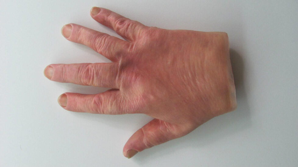 rt-hand-drsl-silicone-restoration