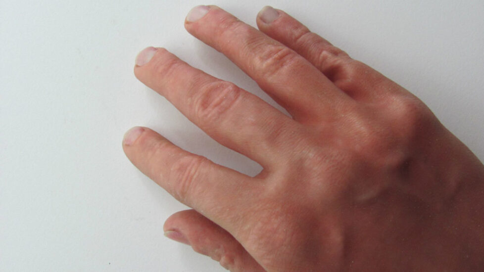 rt-hand-silicone-restoration