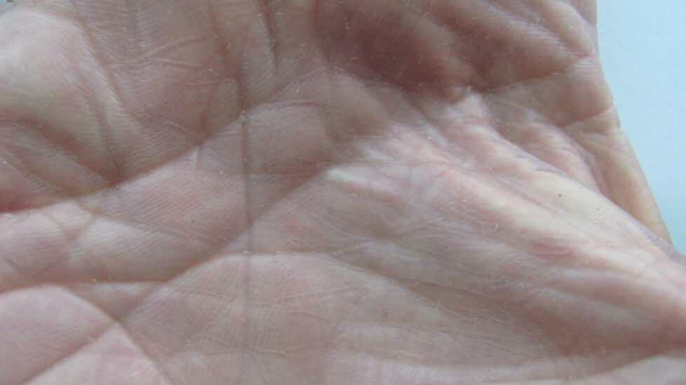 rt-hand-silicone-restoration-palm-detail