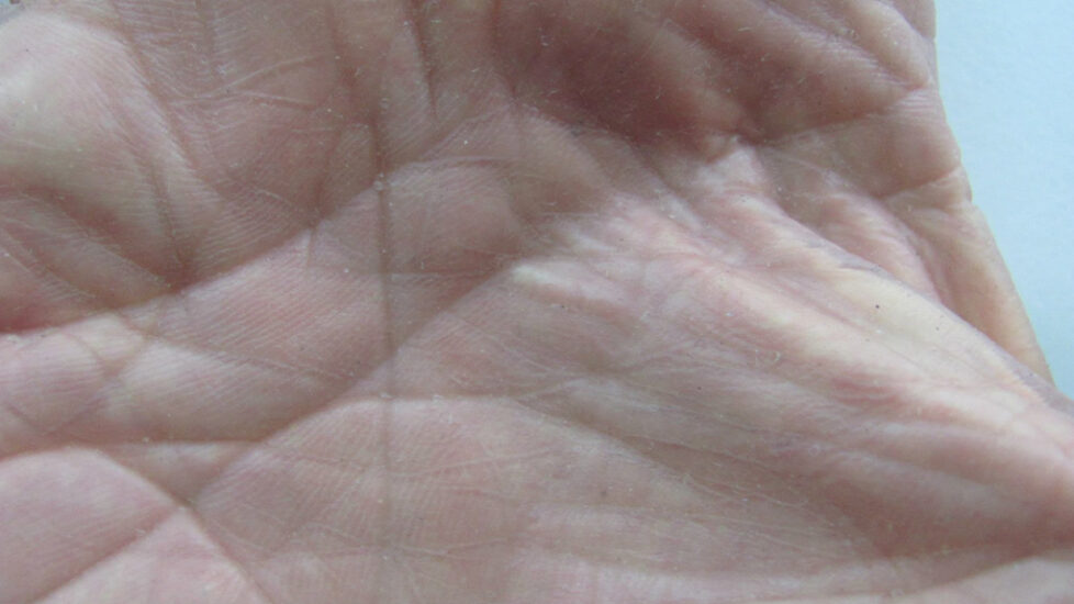 rt-hand-silicone-restoration-palm-detail