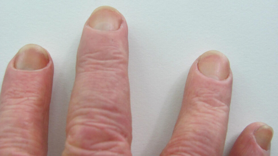 rt-hand-silicone-restoration-tips-detail