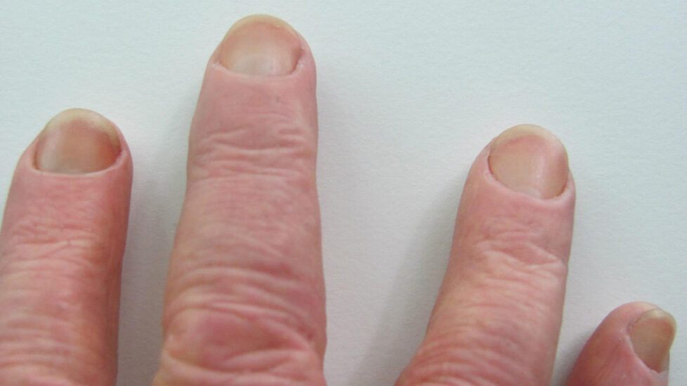 rt-hand-silicone-restoration-tips-detail